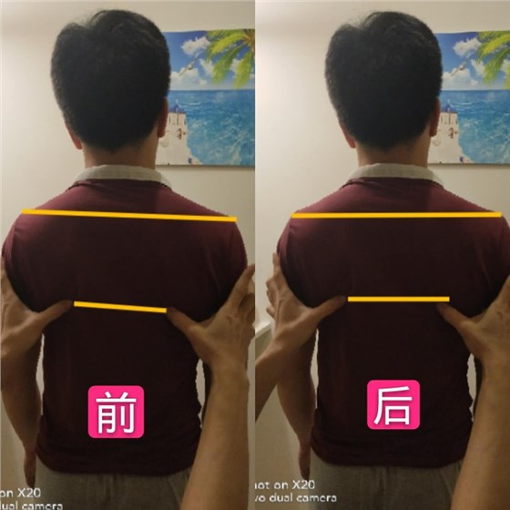 骨盆调整案例