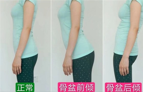 骨盆调整案例