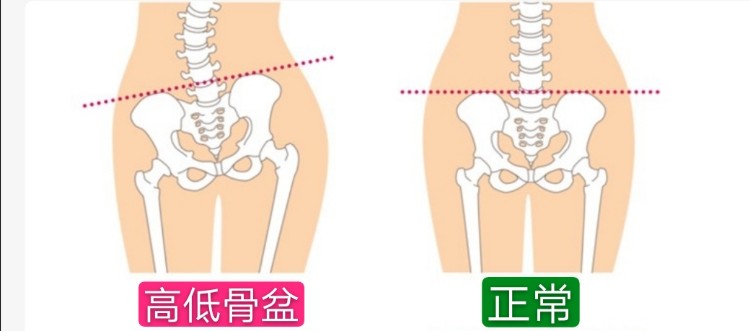 骨盆调整案例