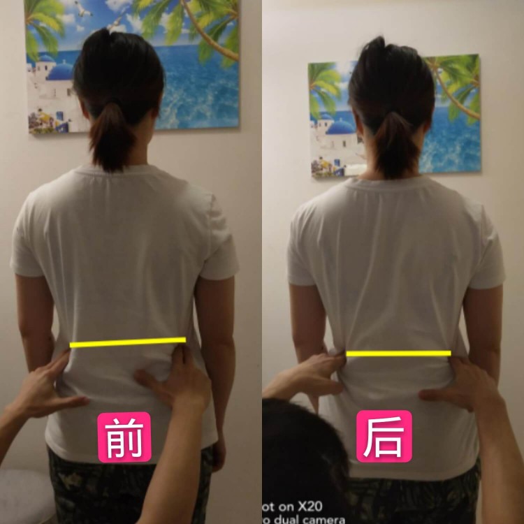 骨盆调整案例
