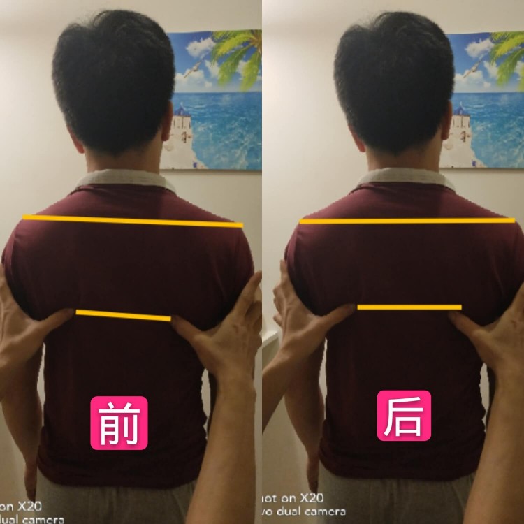 骨盆调整案例