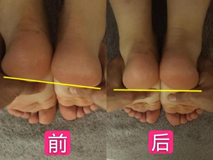 骨盆调整案例