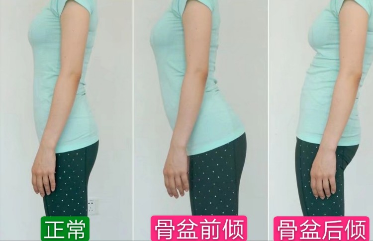 骨盆调整案例