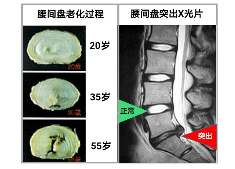 腰间盘突出 腰间盘突出