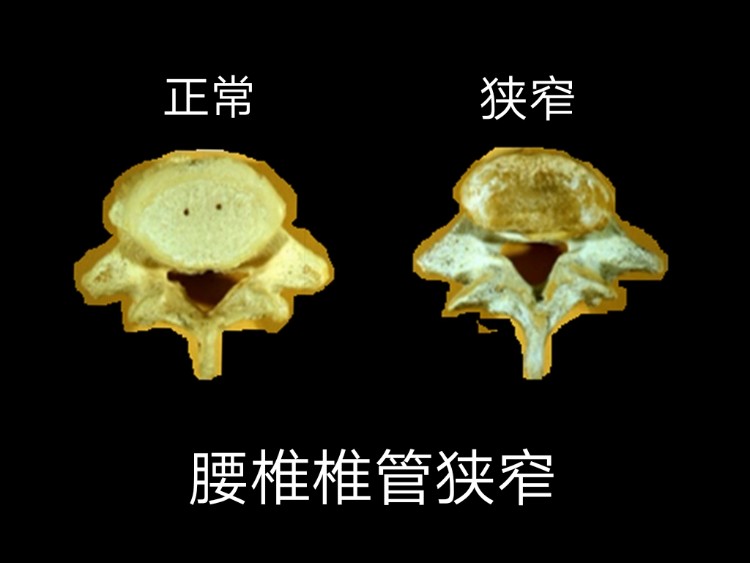 腰椎椎管狭窄